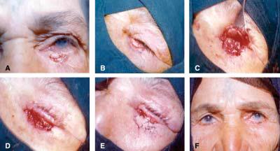 Reconstruction of Eyelid Defects after Excision of Eyelid Tumors